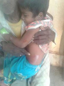 A kid injured during CM visit in Kharsia